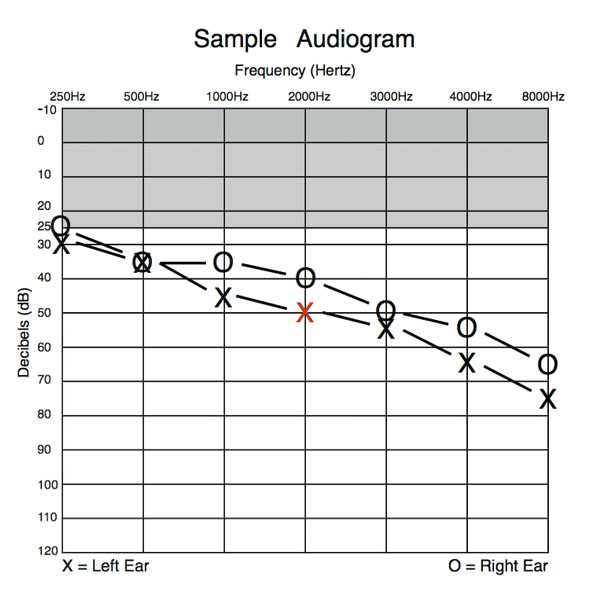 Audiogram sample